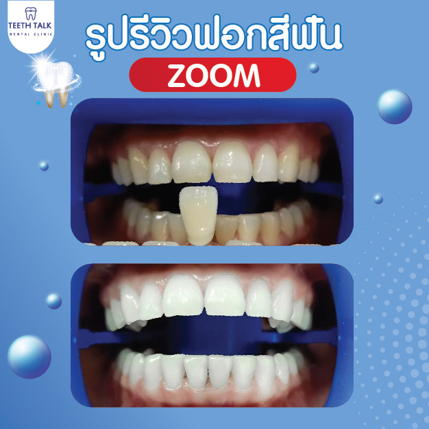 5 วิธีแก้ฟันเหลือง ให้ฟันขาวเร็วมีวิธีไหนบ้าง?