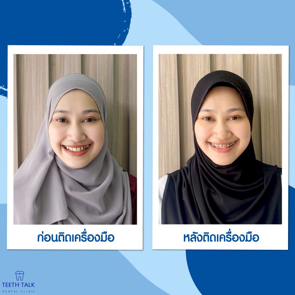จัดฟัน