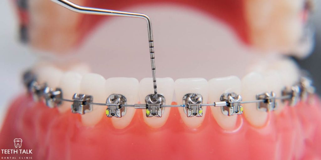 จัดฟันที่ไหนดี 5 เรื่องที่คนจัดฟันครั้งแรกต้องรู้ อ่านจบจองคิวจัดฟันได้เลย!