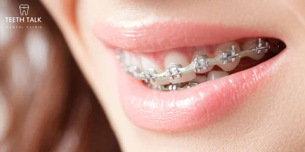 รวม 50 คำถามเกี่ยวกับ จัดฟัน รู้ครบจบที่นี่ที่เดียว! - Teeth Talk Dental  Clinic