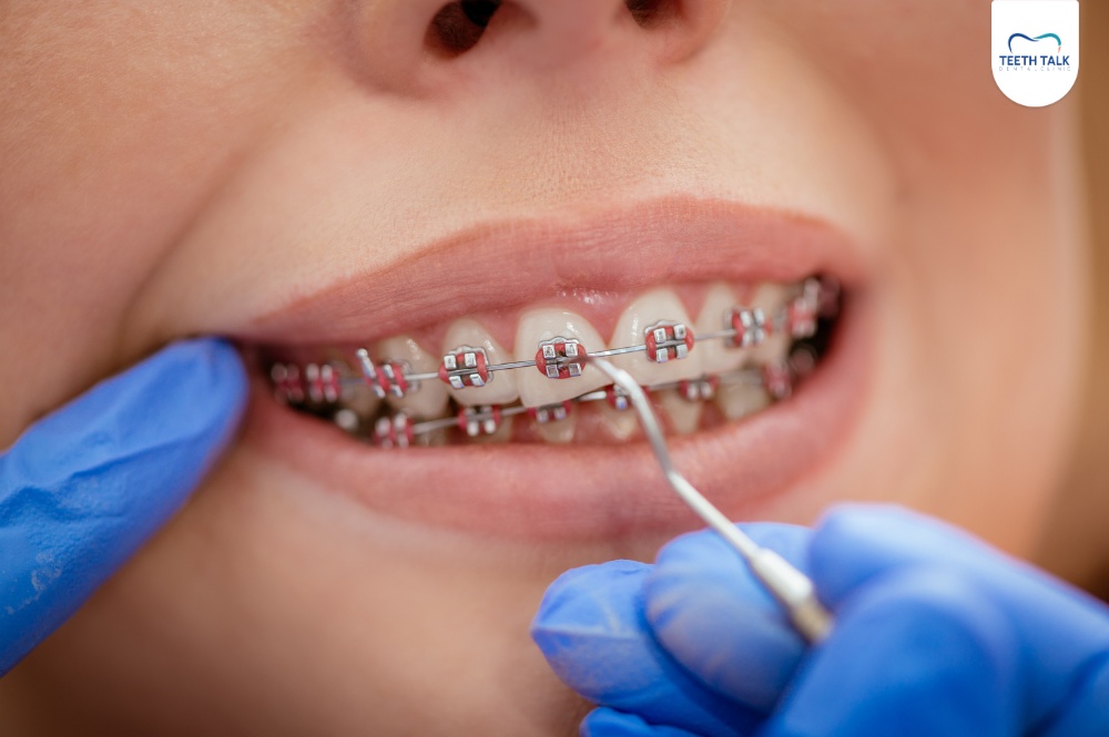 ฟันห่างคืออะไร เกิดจากอะไร รักษาอย่างไร อุดปิดช่องว่างดีไหม เช็กเลย!