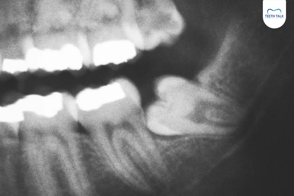 สาเหตุปวดฟันกรามไปถึงหู