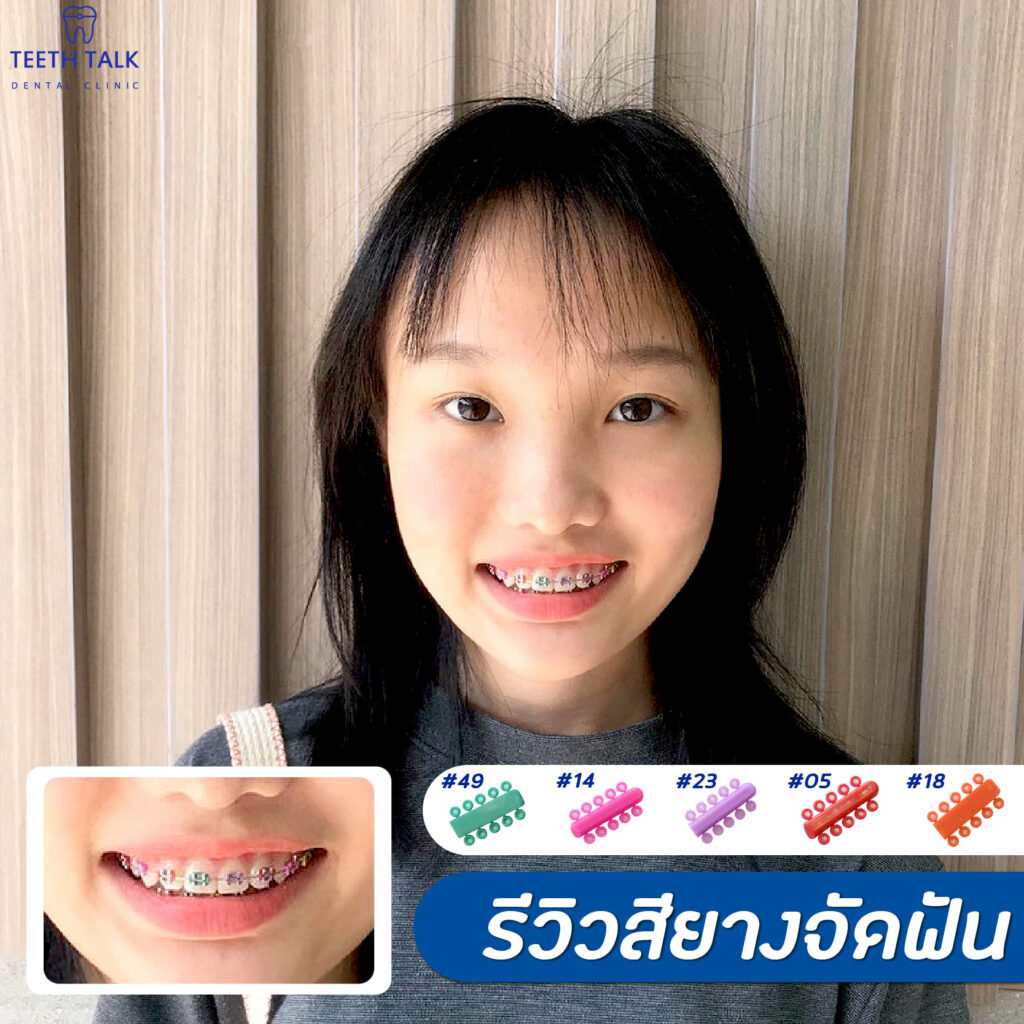 จัดฟันแบบใส Invisalign VS จัดฟันเหล็ก แบบไหนดีกว่ากัน