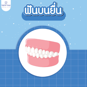จัดฟันเหล็ก จัดฟันโลหะ ดีไหม ราคาเท่าไหร่ รู้ครบจบทุกคำถาม