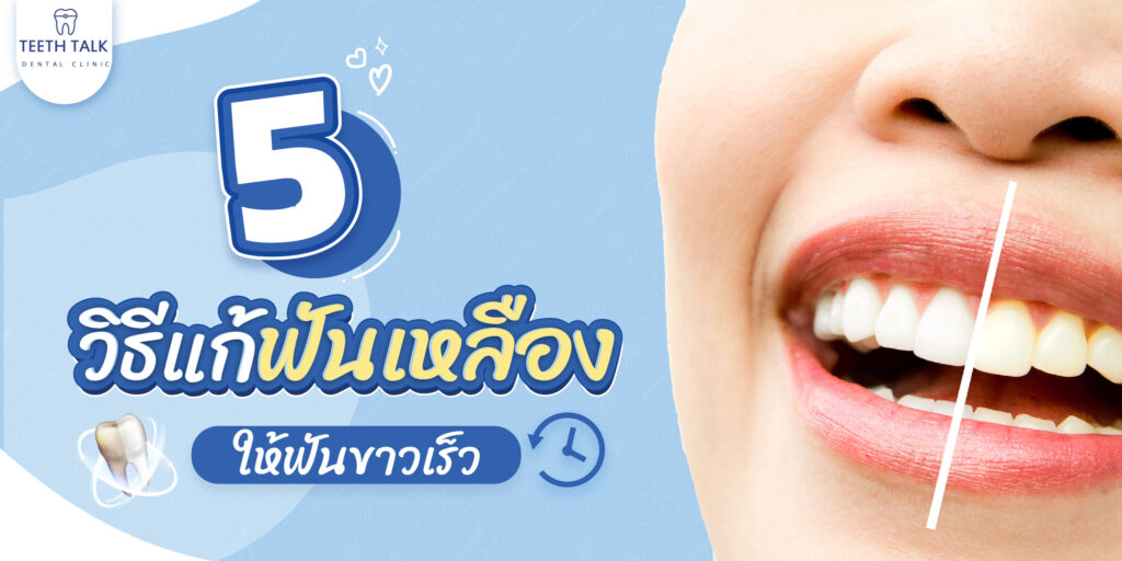 5 วิธีแก้ฟันเหลือง ให้ฟันขาวเร็วมีวิธีไหนบ้าง?