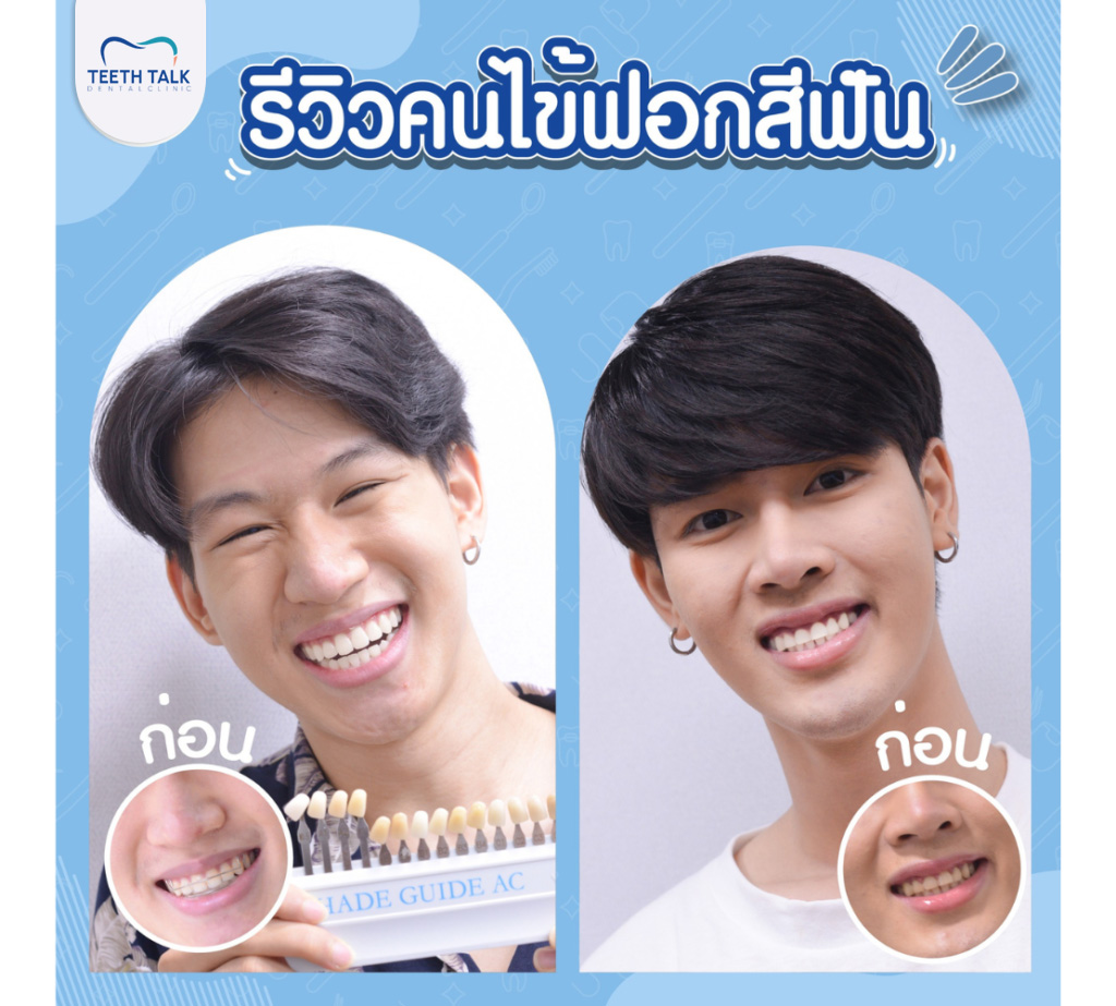 รีวิวฟอกสีฟัน