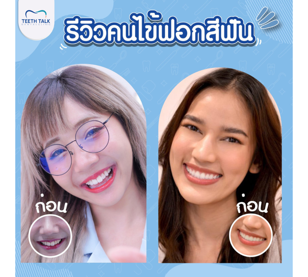 รีวิวฟอกสีฟัน