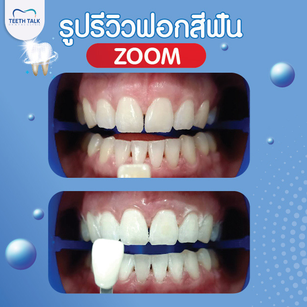 รีวิวฟอกสีฟัน