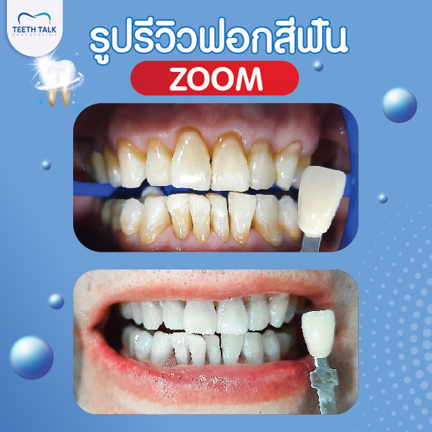 รีวิวฟอกสีฟัน