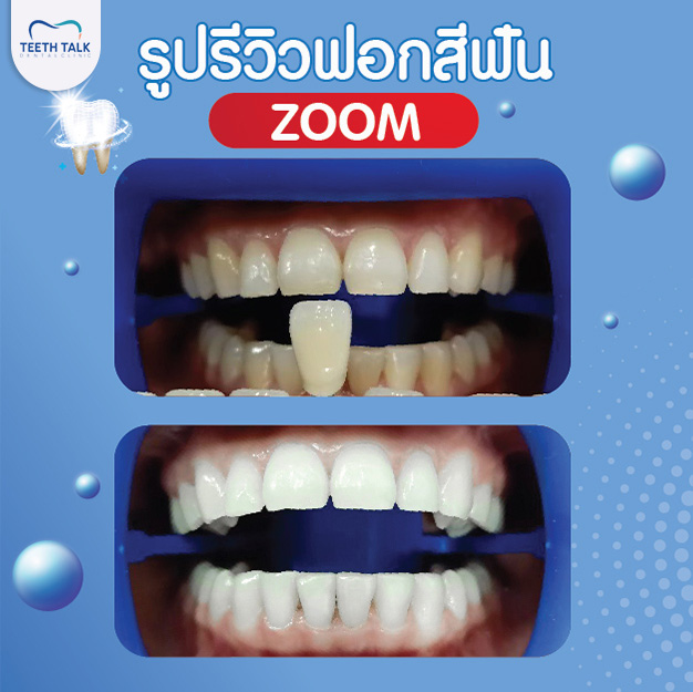 รีวิวฟอกสีฟัน