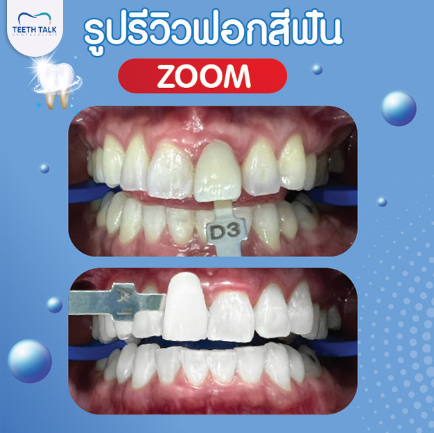 รีวิวฟอกสีฟัน