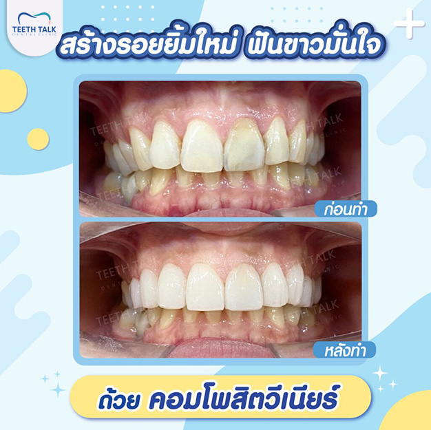 รีวิวการทำวีเนียร์