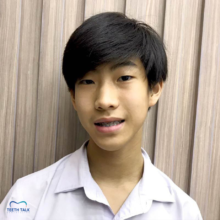 how-many-years-does-braces-take_02 อายุของคนไข้ มีผลกับการเคลื่อนฟันเหมือนกันนะ