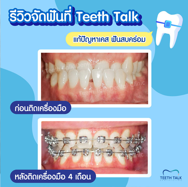 สภาพฟันเป็นยังไง ปัญหาเยอะแค่ไหน