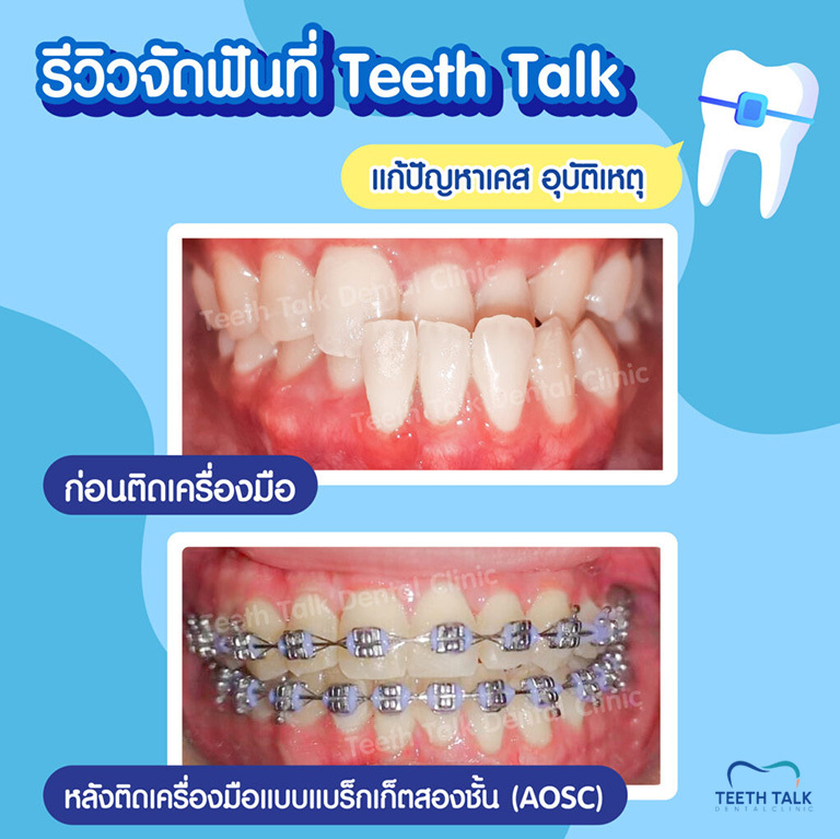 สภาพฟันเป็นยังไง ปัญหาเยอะแค่ไหน