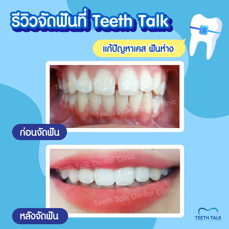 สภาพฟันเป็นยังไง ปัญหาเยอะแค่ไหน