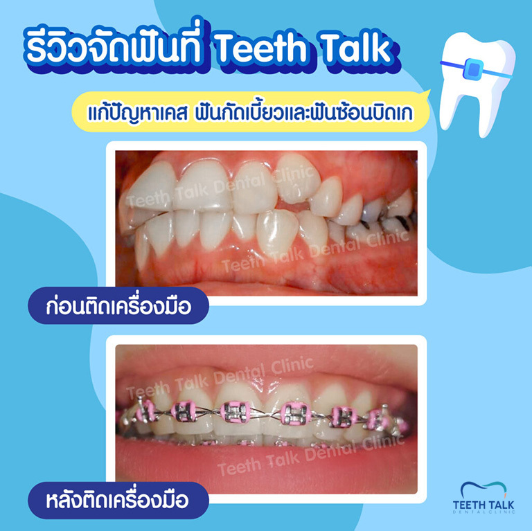 สภาพฟันเป็นยังไง ปัญหาเยอะแค่ไหน