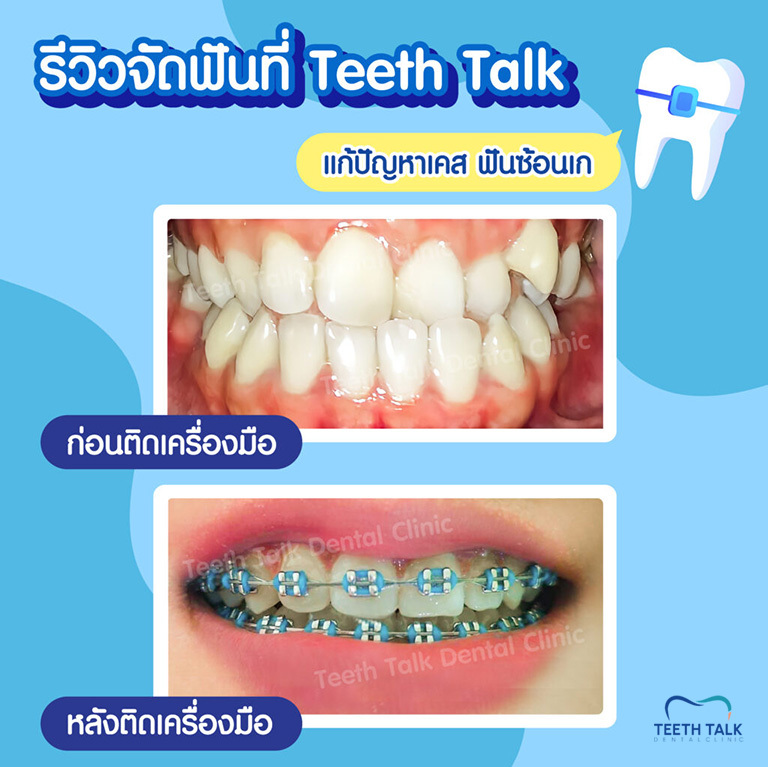 สภาพฟันเป็นยังไง ปัญหาเยอะแค่ไหน