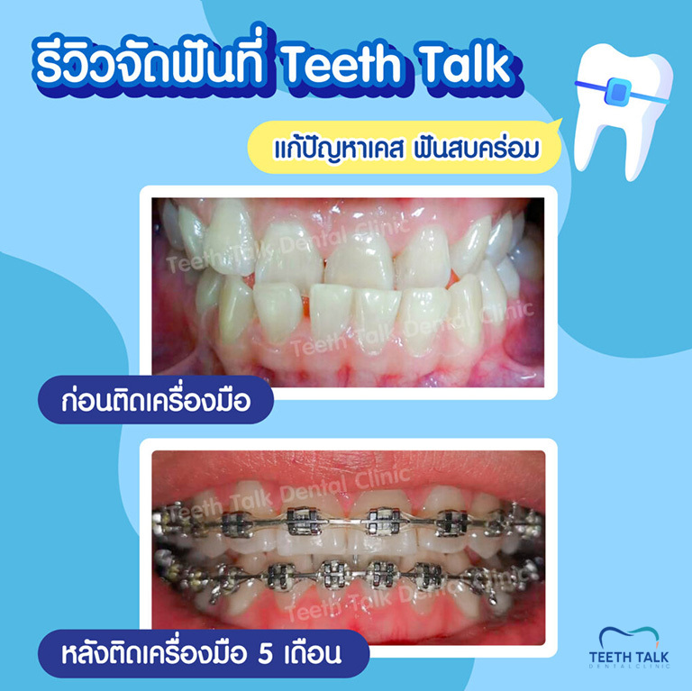 สภาพฟันเป็นยังไง ปัญหาเยอะแค่ไหน