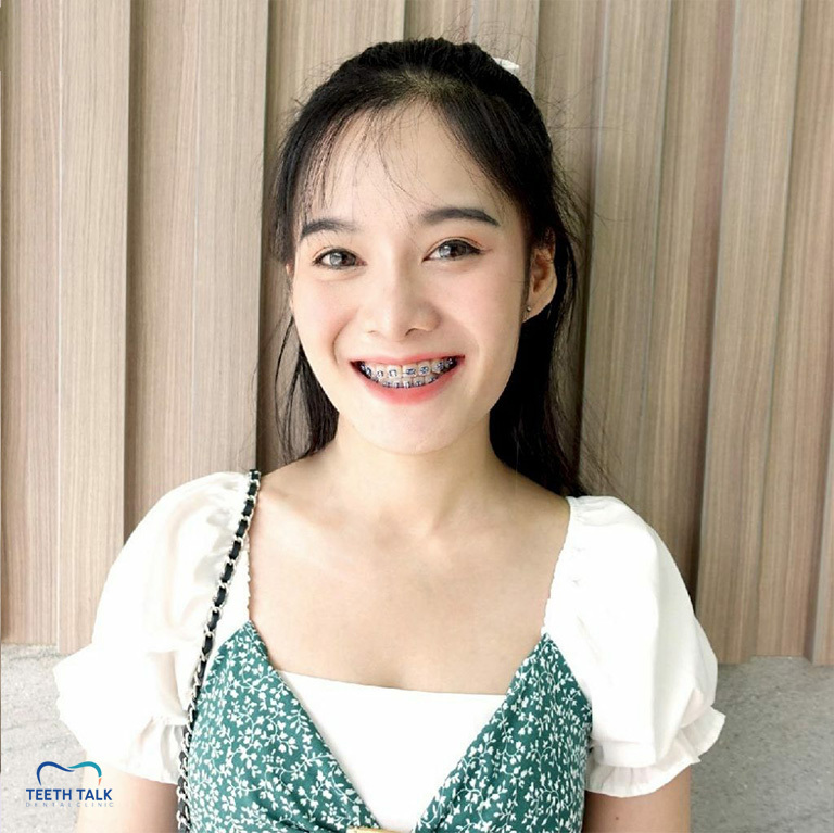 จัดฟันใช้เวลากี่ปี อะไรที่ทำให้จัดฟันเสร็จช้า