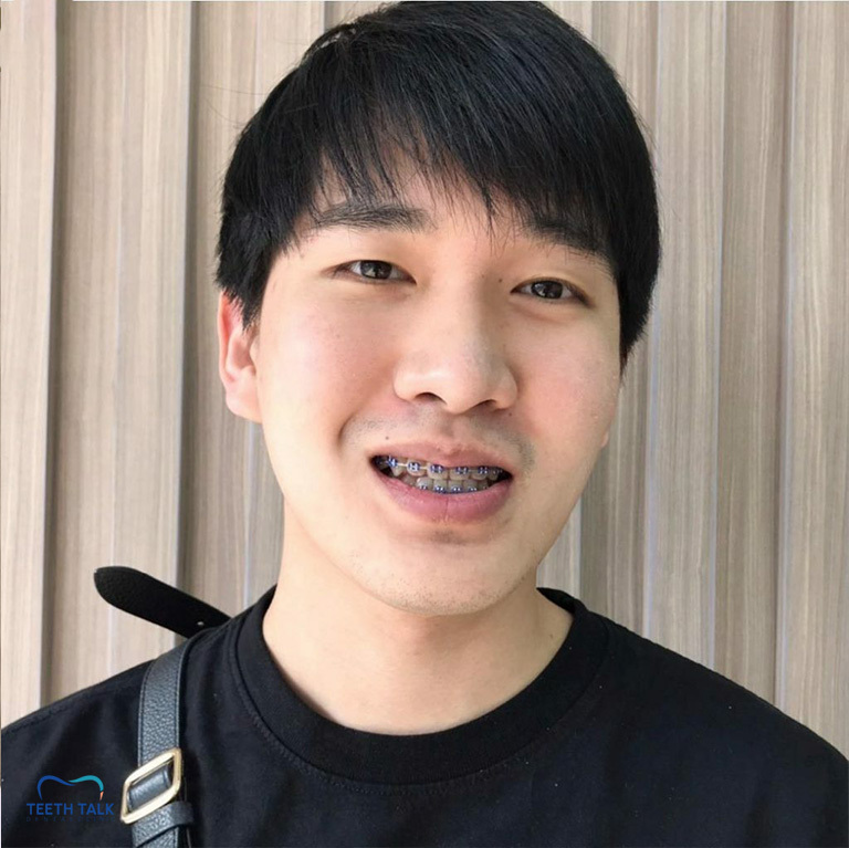 จัดฟันใช้เวลากี่ปี อะไรที่ทำให้จัดฟันเสร็จช้า