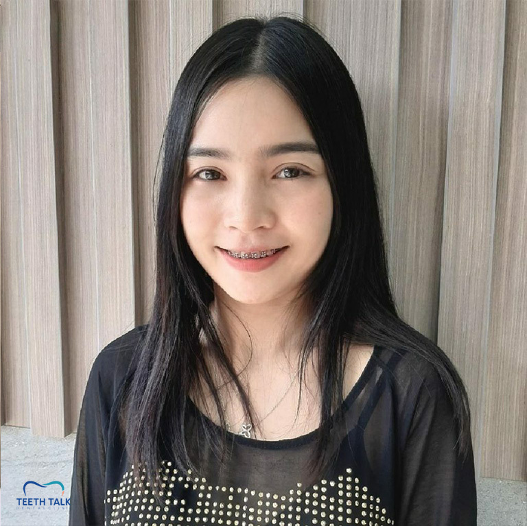 จัดฟันใช้เวลากี่ปี อะไรที่ทำให้จัดฟันเสร็จช้า