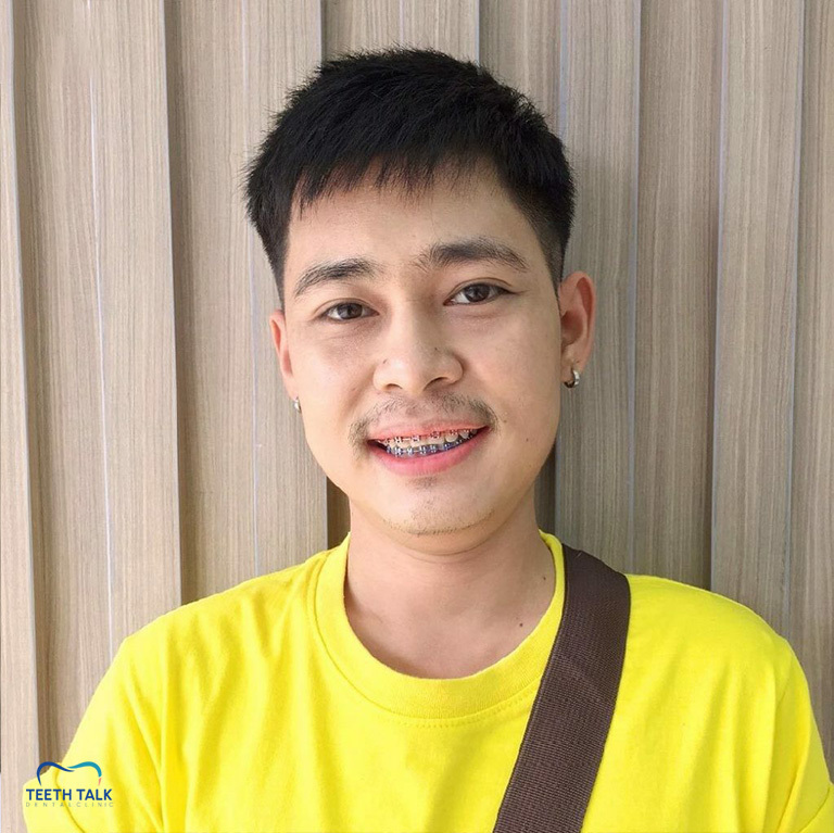 จัดฟันใช้เวลากี่ปี อะไรที่ทำให้จัดฟันเสร็จช้า