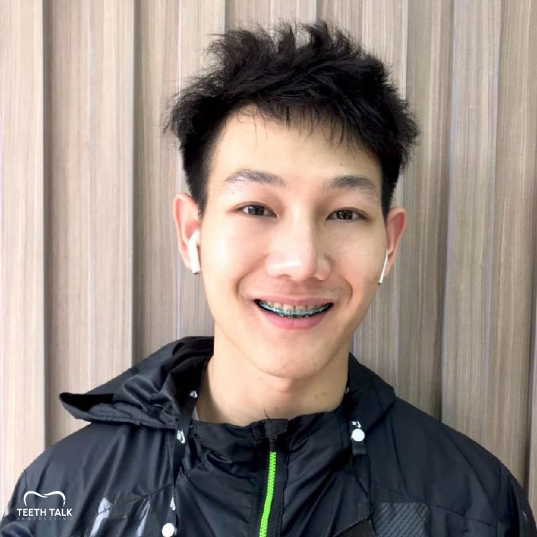 จัดฟันใช้เวลากี่ปี อะไรที่ทำให้จัดฟันเสร็จช้า