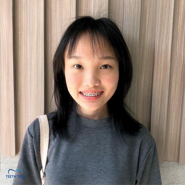 จัดฟันใช้เวลากี่ปี อะไรที่ทำให้จัดฟันเสร็จช้า