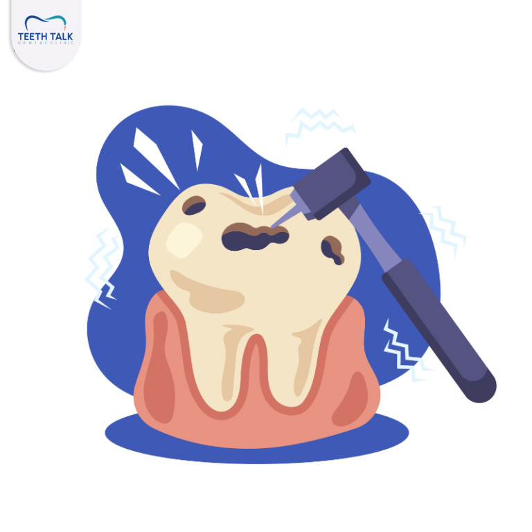 การซ่อมแซมเนื้อฟันที่มีรอยผุโดยทันตแพทย์