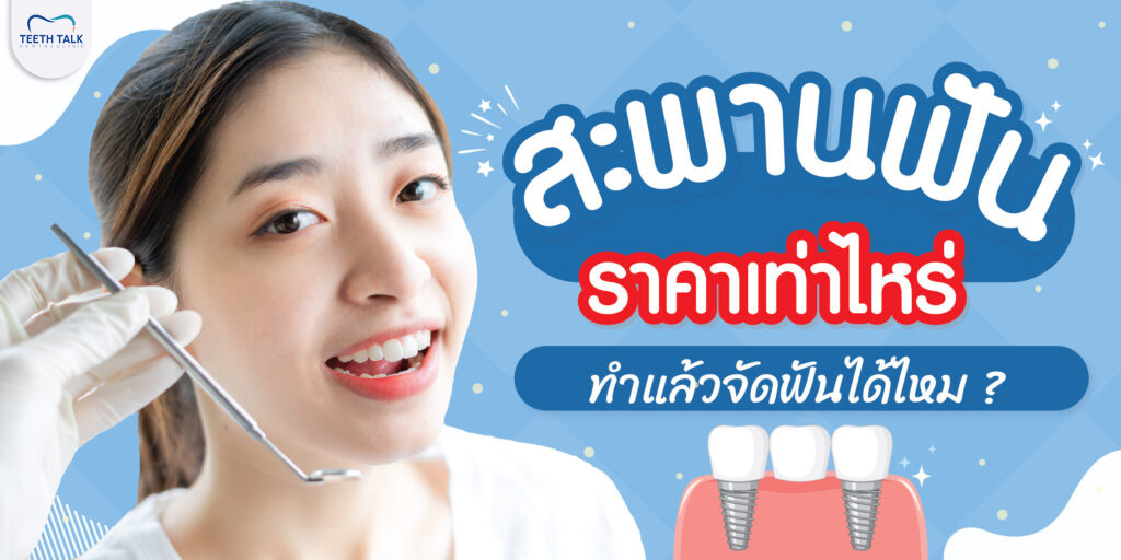 สะพานฟัน คืออะไร ราคาเท่าไหร่ รวมข้อดีข้อเสียครบจบในบทความเดียว