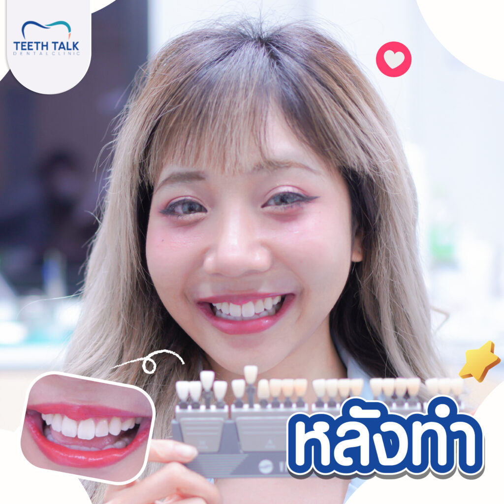 รีวิวฟอกสีฟัน