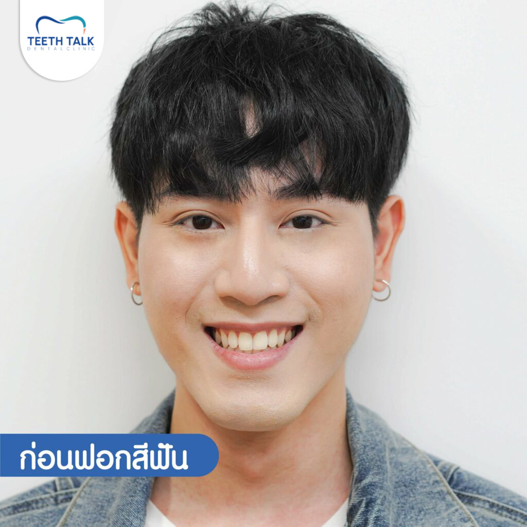 ก่อนฟอกสีฟัน