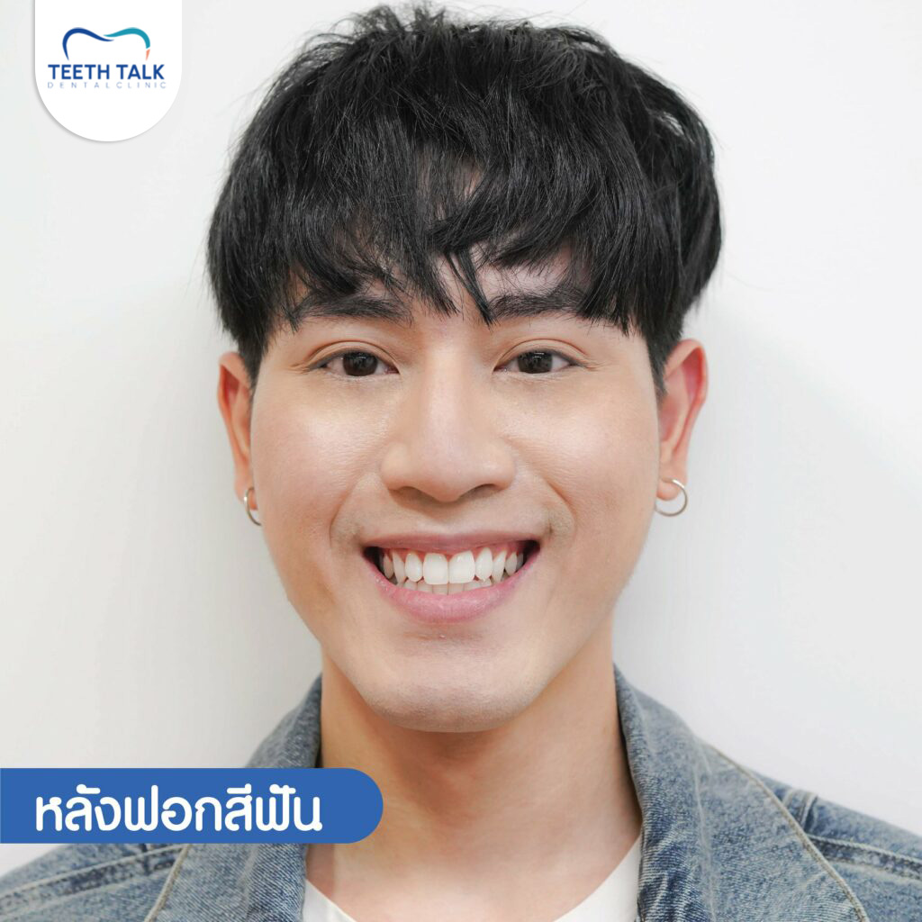 หลังฟอกสีฟัน