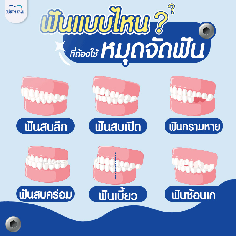 ฟันแบบไหน ที่ต้องใช้หมุดจัดฟัน