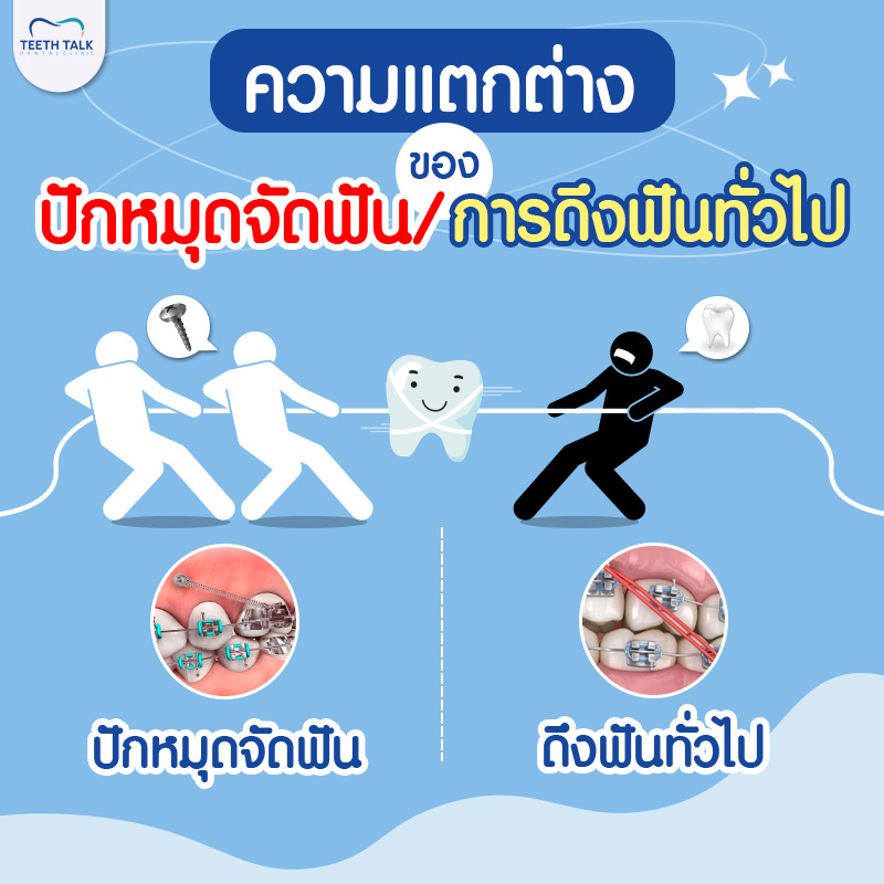 ความแตกต่างของ ปักหมุดจัดฟัน/การดึงฟันทั่วไป