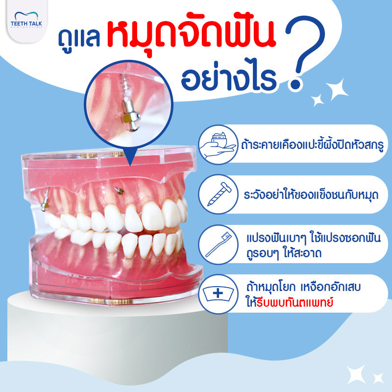 ดูแลหมุดจัดฟันอย่างไร?