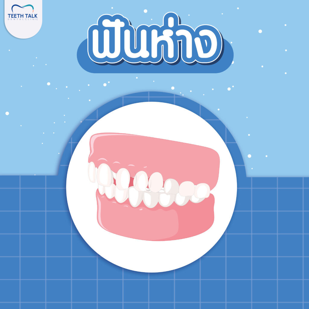 ฟันห่าง