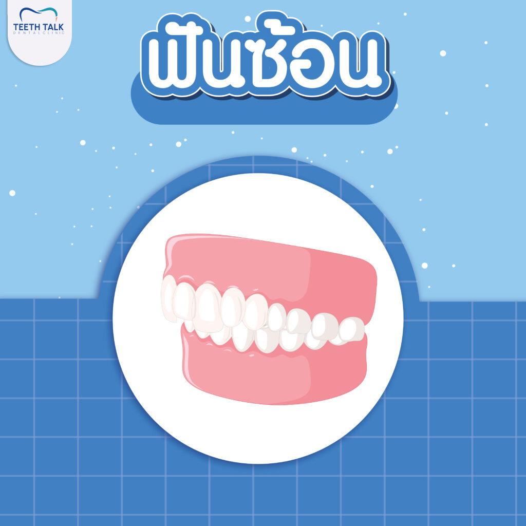 ฟันซ้อม