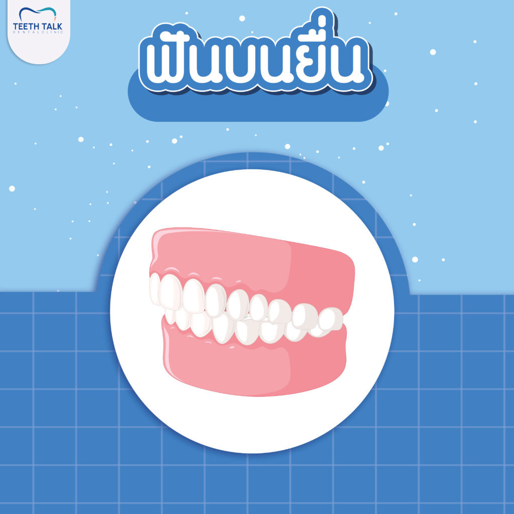 ฟันบนยื่น