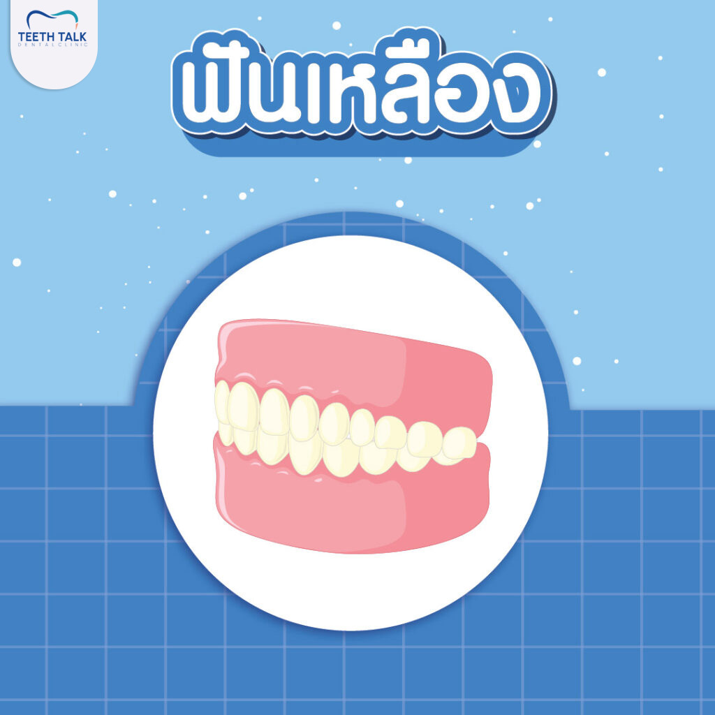 ฟันเหลือง