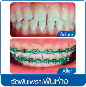 ทำฟันประกันสังคม ไม่ต้องสำรองจ่ายทำอะไรได้บ้าง?