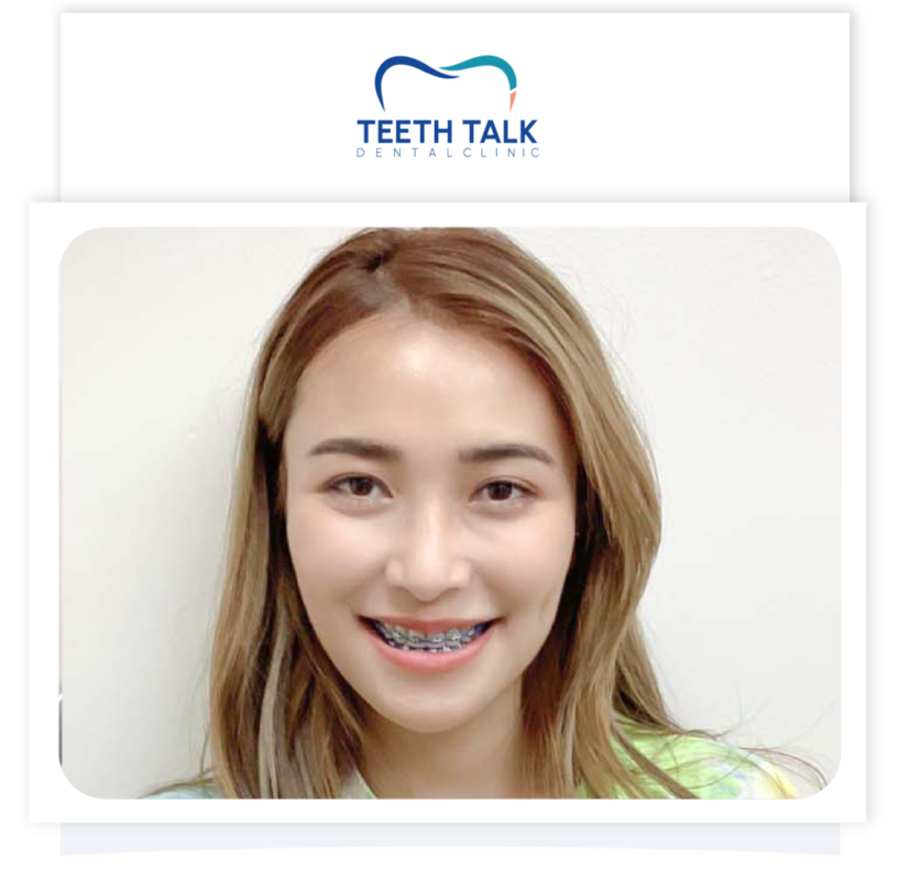 รีวิวจัดฟัน ทำฟัน ถอดฟัน คลินิกทำฟัน teethtalk-clinic
