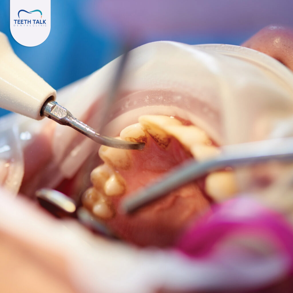 10 เหตุผลทำไมต้อง ขูดคราบหินปูน ดีต่อช่องปากอย่างไร? ถ้าไม่ขูดส่งผลอะไรบ้าง?