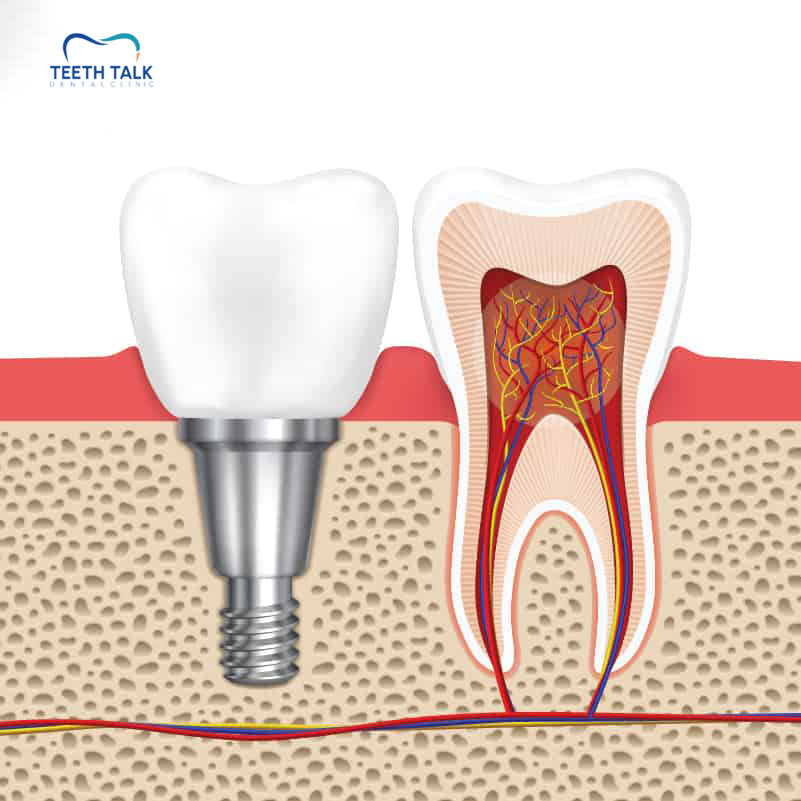 การป้องกันรากฟันเทียมอักเสบมีวิธีใดบ้าง?