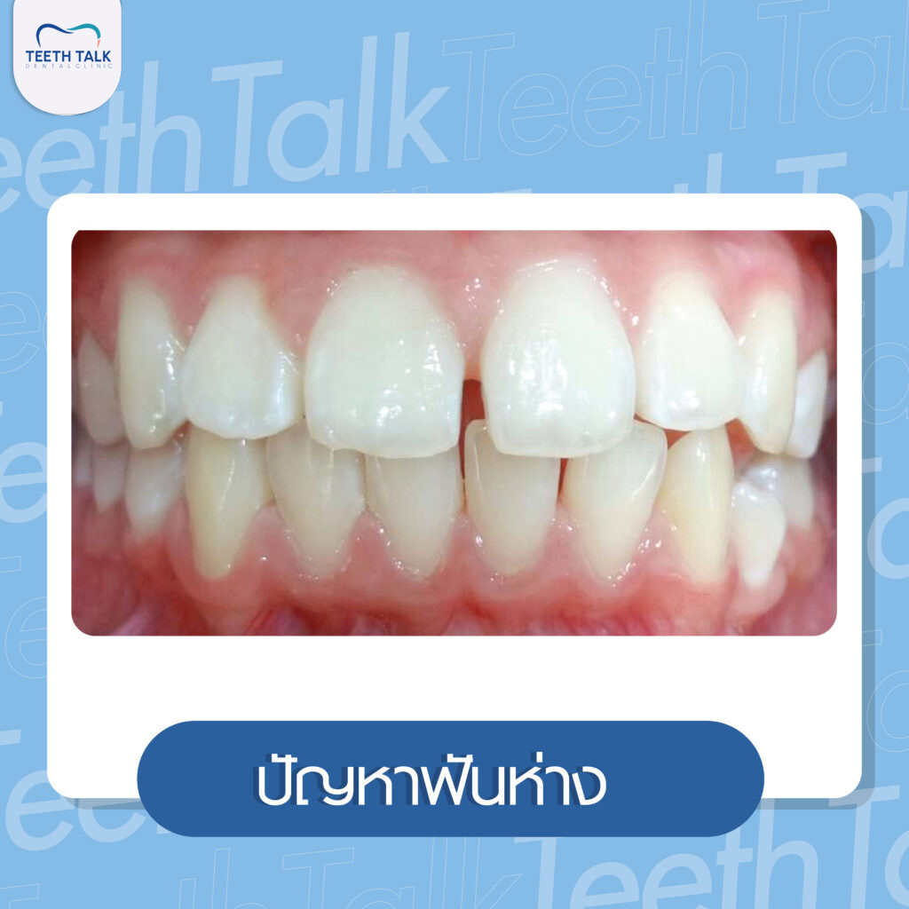 ปัญหาฟันหน้าห่างแก้ยังไงดี