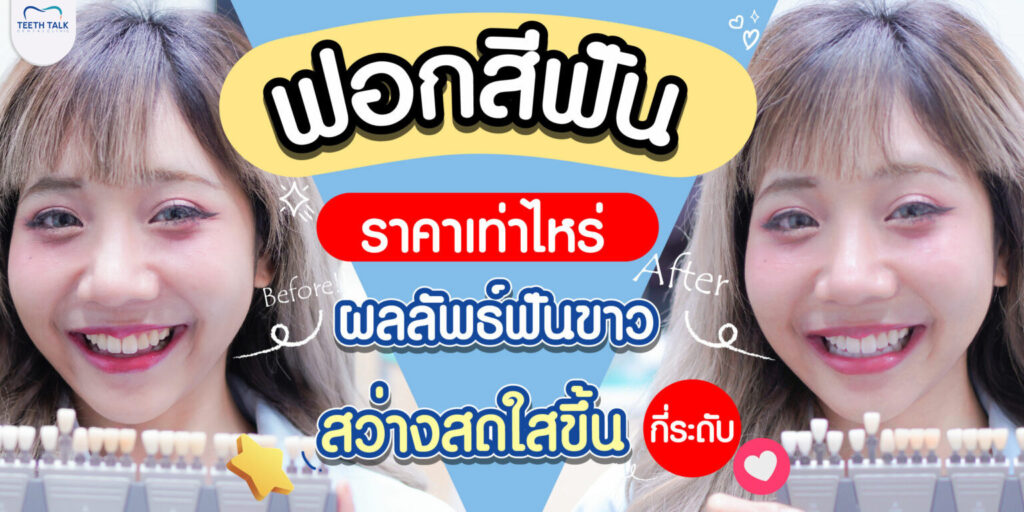 ฟอกสีฟันราคาเท่าไหร่ ?