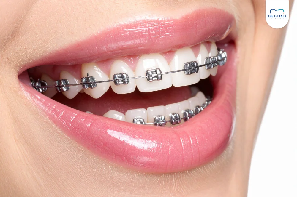 ค่าใช้จ่ายในการถอดเหล็กจัดฟัน