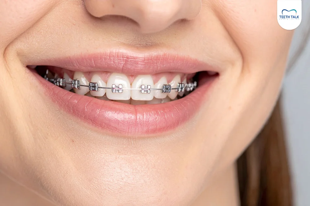 จัดฟันเหล็กมีกี่แบบ