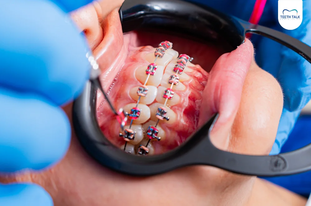 ขั้นตอนการจัดฟันเหล็ก